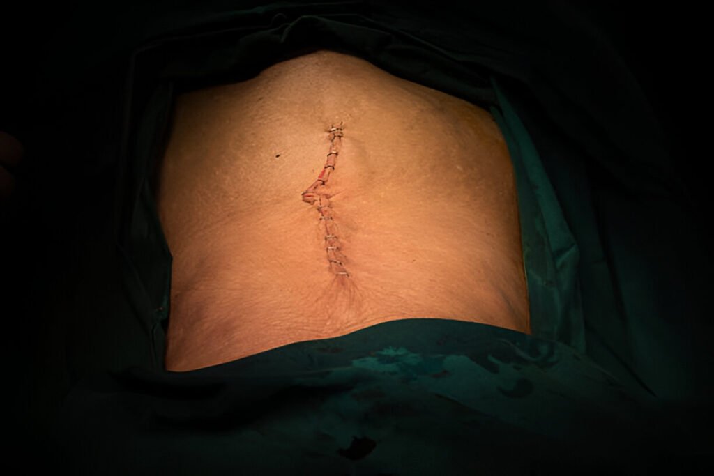 Failed Back Surgery Syndrome ozone therapy Jalandhar- Dr. Nayyar